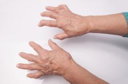 hands with rheumatoid arthritis